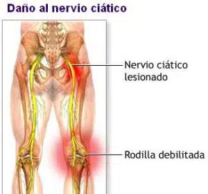 nervio_ciatico