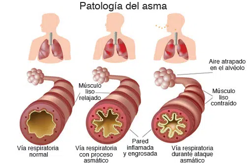 patol-asma