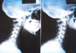 Corrección latigazo cervical con sesiones de quiropráctica