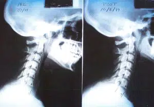 Corrección latigazo cervical con sesiones de quiropráctica