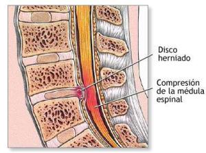 hernia discal