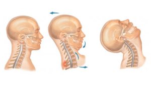 Latigazo cervical