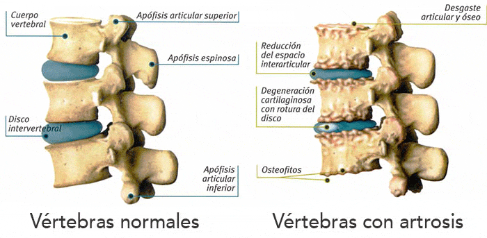 Osteoartritis y quiropráctica