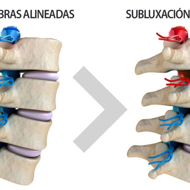 La subluxación vertebral