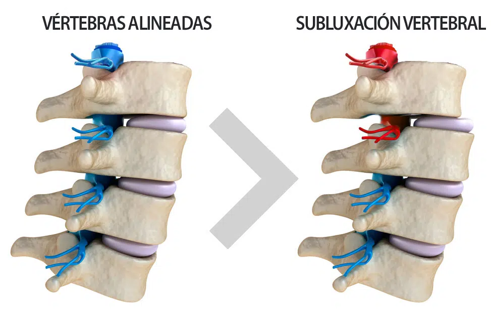 La subluxación vertebral