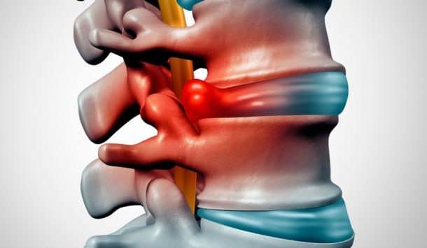 La hernia discal y la quiropráctica parte uno