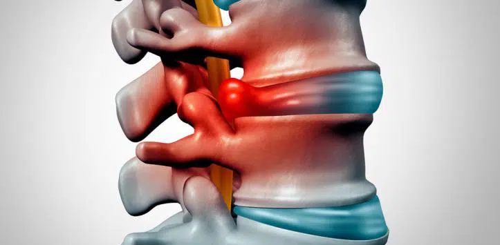 La hernia discal y la quiropráctica parte uno