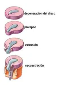 etapas hernia discal