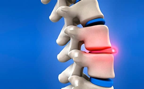 hernia discal hernia de disco