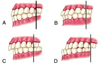 Mala oclusión dental. Relación entre los dientes y el dolor cervical