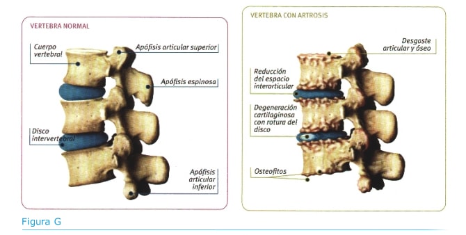 Artritis y quiropráctica
