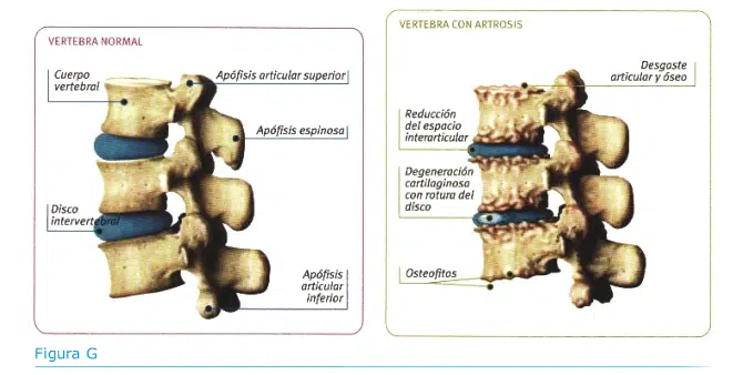 Artritis y quiropráctica