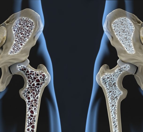 Osteoporosis y Quiropráctica