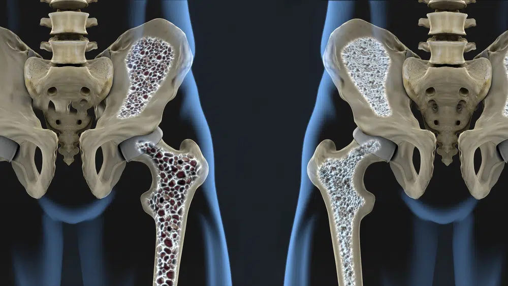 Osteoporosis y Quiropráctica