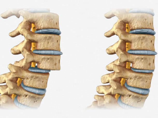Espondilolistesis y quiropráctica