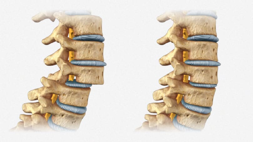 Espondilolistesis y quiropráctica