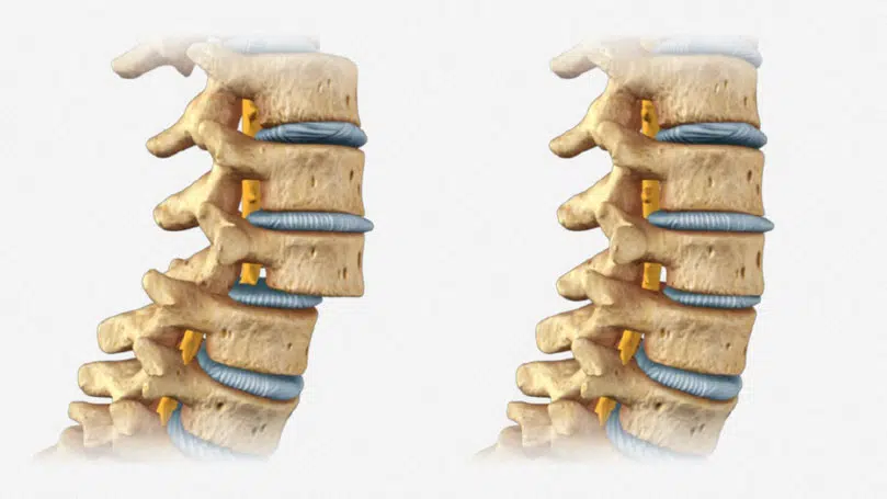 Espondilolistesis y quiropráctica