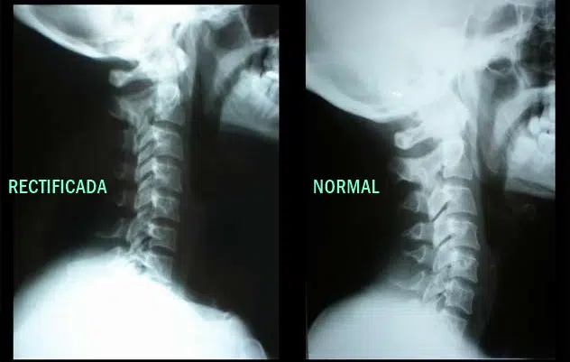 Lordosis cervical - Barcelona Quiropractic