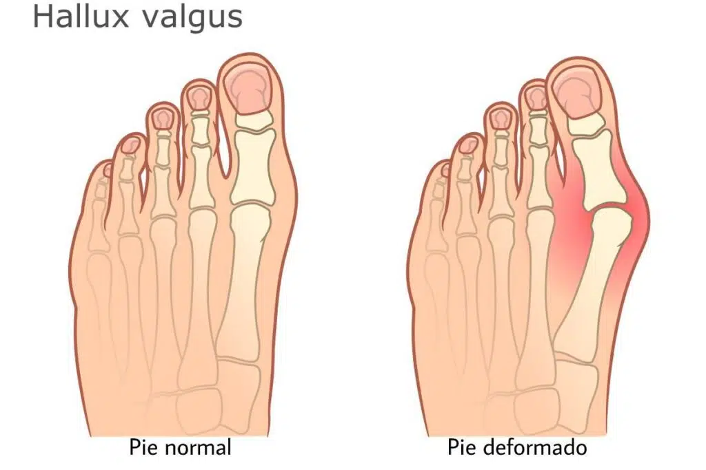 calzado-y-dolor-de-pies