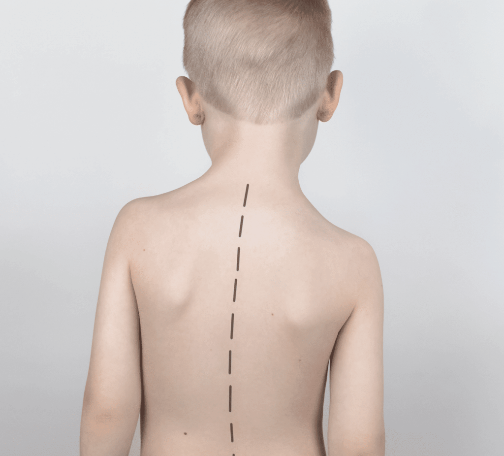 escoliosis en niños